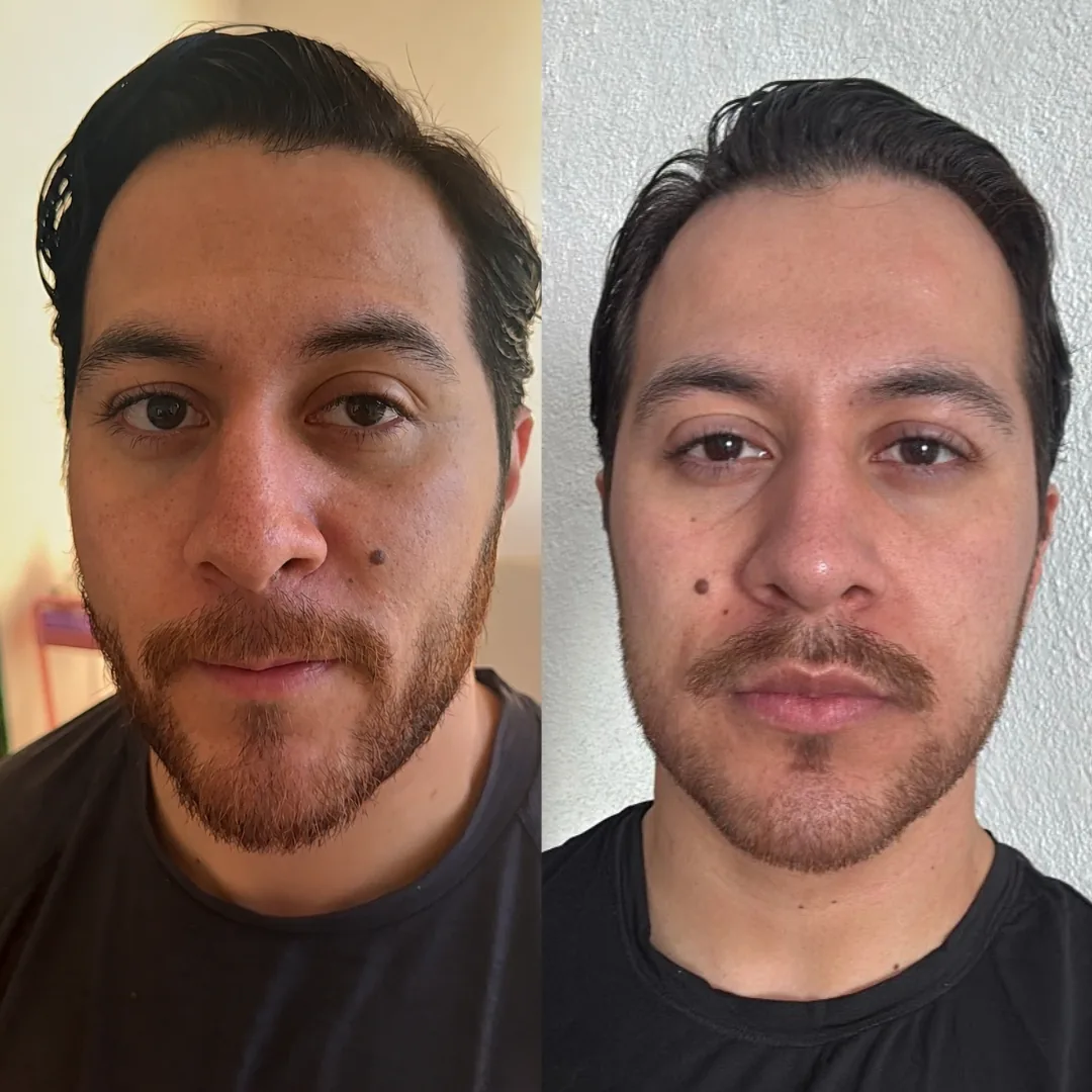 Resultado de tratamiento facial - antes y después