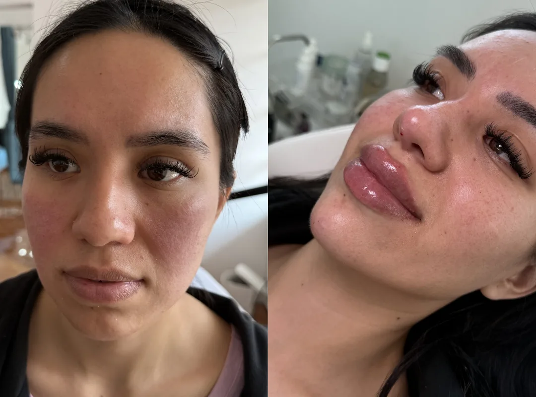 Resultado de diseño de labios - antes y después